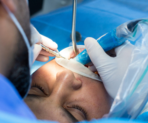 Root Canal