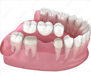 Zirconia Crown & Bridge