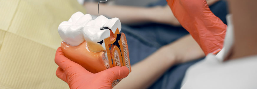 Root Canal Treatments
