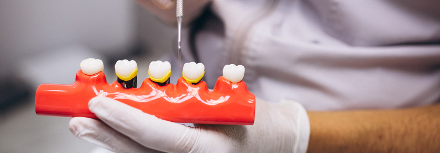 Dental Crowns and Bridges