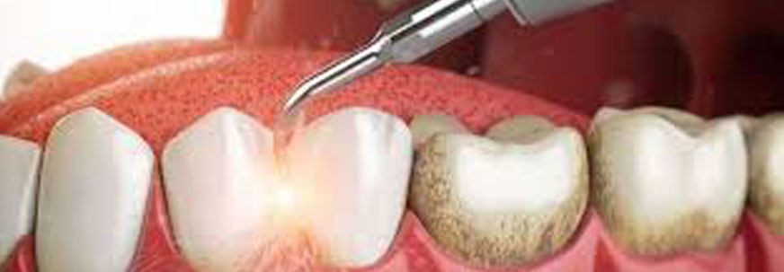 Scaling and Polishing at Al Dhabi Dental and Orthodontic Centre