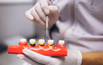 Dental Crowns and Bridges