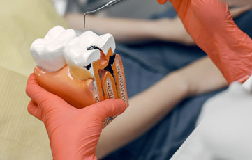 Root Canal Treatments 