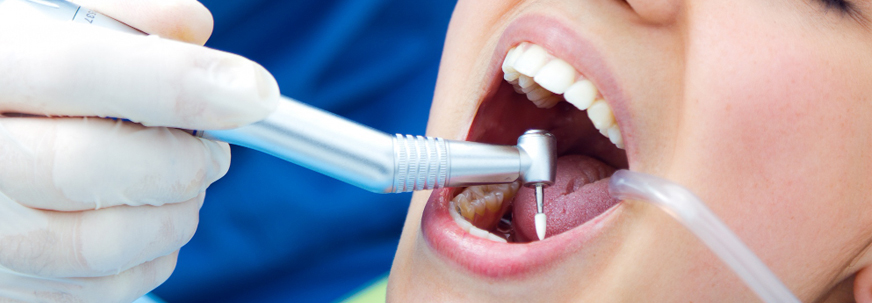 Tooth Filling